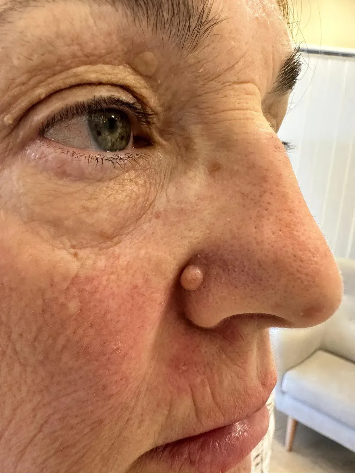 Vista de perfil del rostro de una persona; protuberancia prominente de color claro en la nariz. 