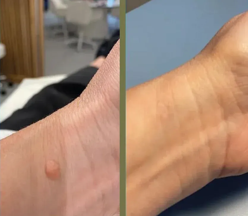 Antes y después de una muñeca; el bulto visible ha desaparecido. El tono de piel es claro.