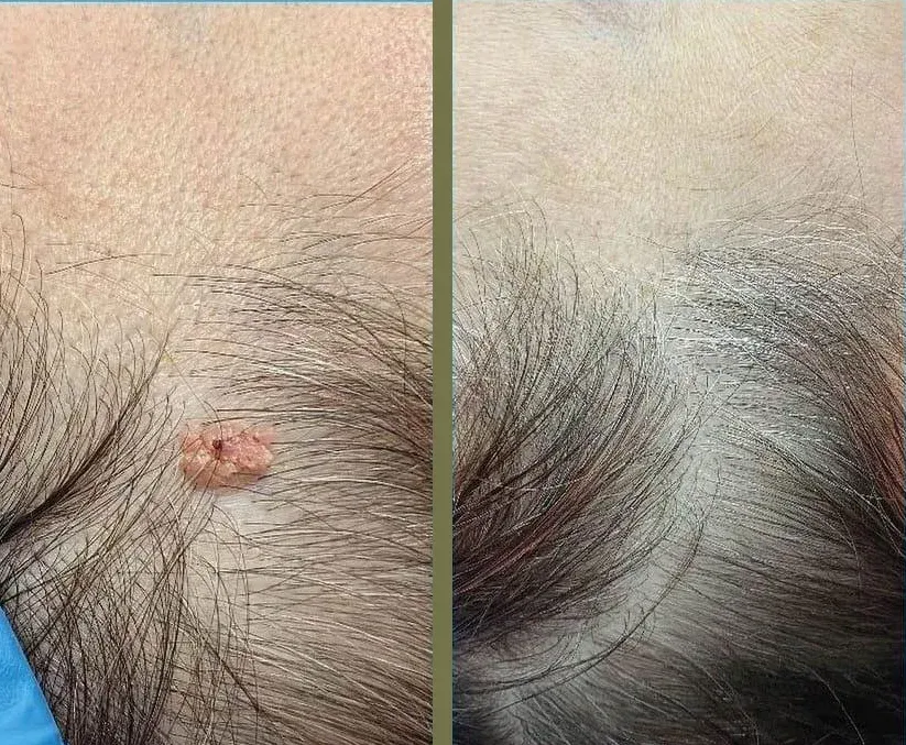 Vista antes y después de un crecimiento de piel en el cuero cabelludo;