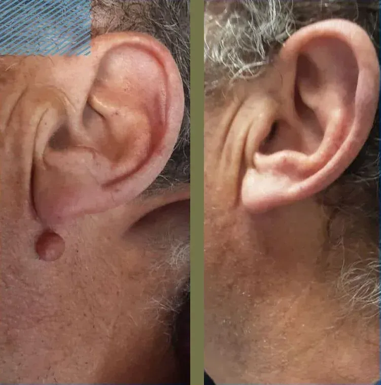 Dos fotografías, una al lado de la otra, de la oreja de una persona