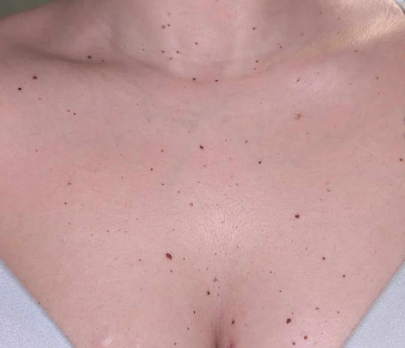 Pecho y parte superior del torso con múltiples lunares marrones.