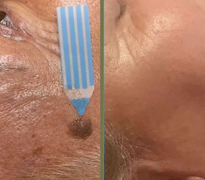 Fotos de la piel antes y después: el lado izquierdo muestra una cara con una mancha oscura