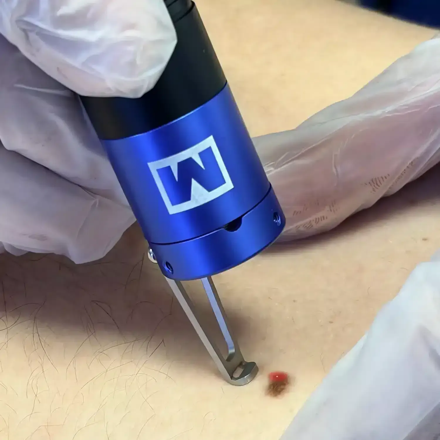 Una mano enguantada sostiene un dispositivo médico azul sobre un lunar en la piel.