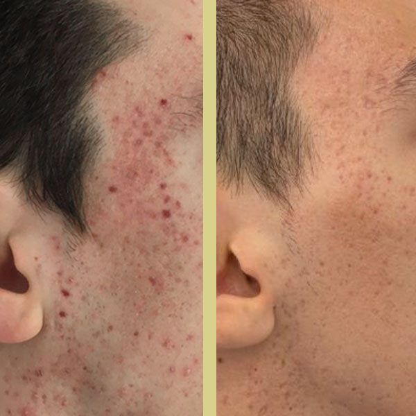 Vista de lado a lado de un rostro con acné antes (izquierda) y después (derecha) del tratamiento
