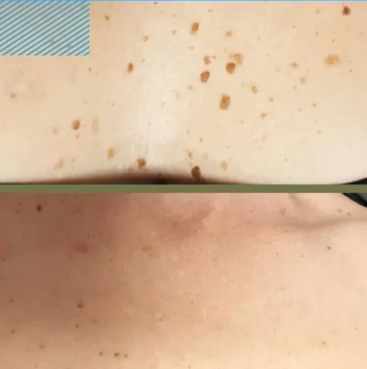 Primer plano de la piel. La sección superior muestra múltiples lunares marrones. La sección inferior muestra menos lunares.