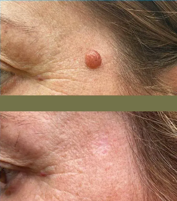 Antes y después de la extirpación de una lesión cutánea en la frente. Arriba: crecimiento rojizo y elevado. Abajo: piel lisa.