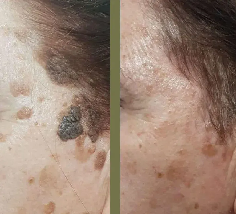 Fotografías de piel antes y después, que muestran la eliminación de un lunar grande y oscuro.