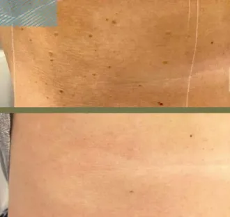 Vista de la piel antes y después; la imagen superior muestra piel con manchas oscuras