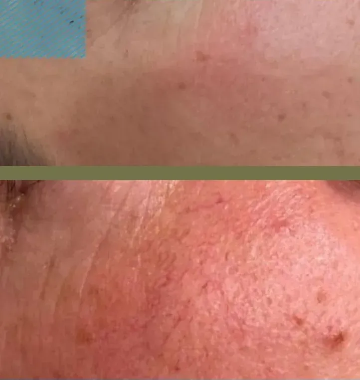 Comparación de la piel antes y después del tratamiento, que muestra una reducción del enrojecimiento y las imperfecciones.