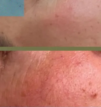 Comparación de la piel antes y después del tratamiento, que muestra una reducción del enrojecimiento y las imperfecciones.