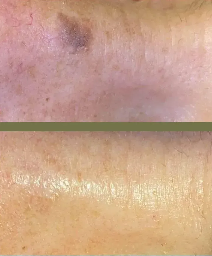 Fotografía de la piel antes y después, que muestra una mancha oscura que se desvanece.