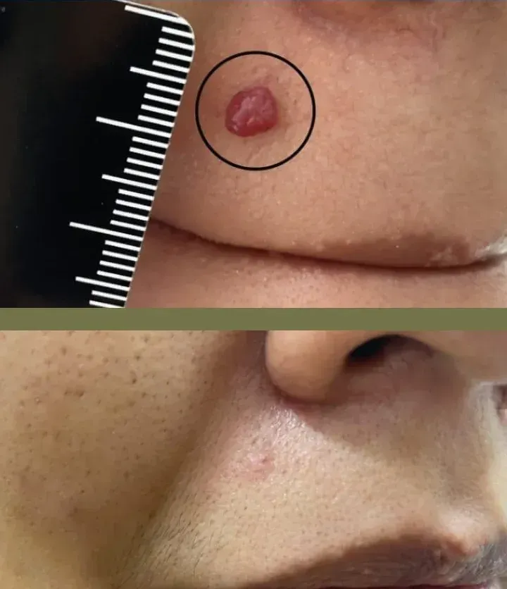 Dos imágenes: un primer plano de la piel con un bulto rojizo, elevado y en forma de círculo,