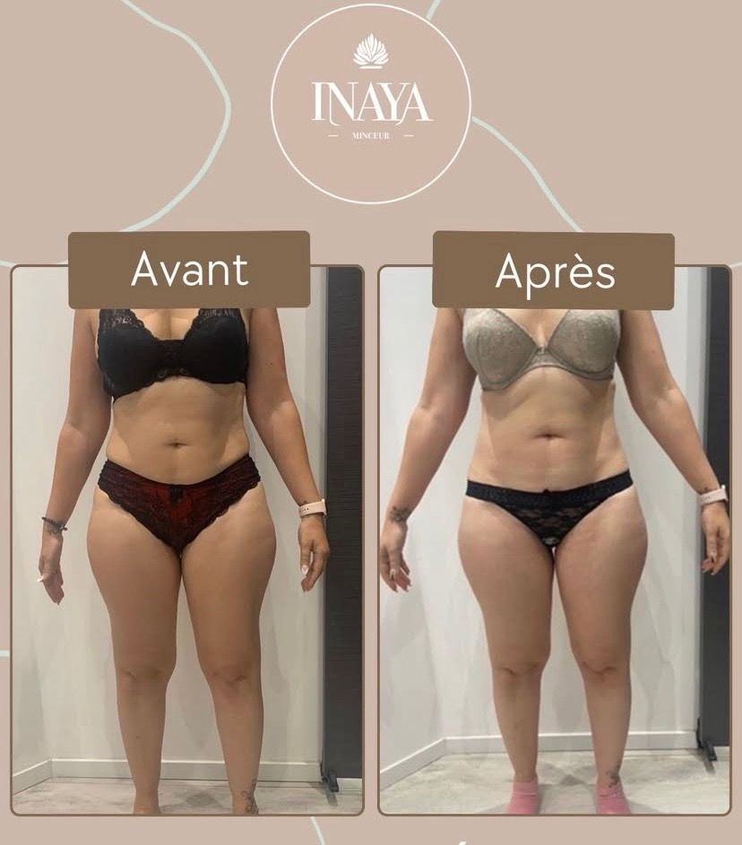Femme avant et après une séance de cryolipolyse.