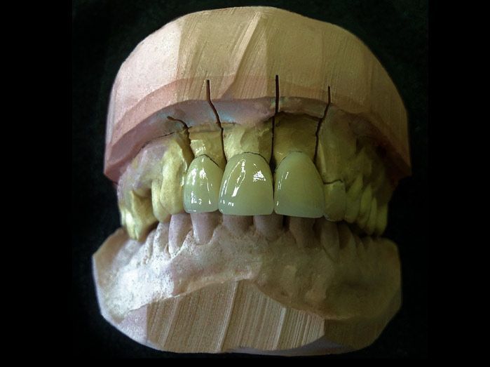 Un primer plano de un modelo de los dientes de una persona sobre una mesa.