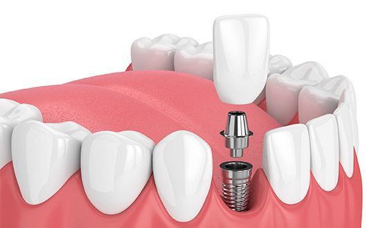 Un primer plano de un diente con un implante dental en él.