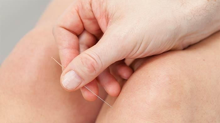 Eine Person bekommt Akupunktur am Bein.
