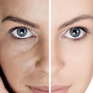 Se muestra el rostro de una mujer antes y después de un tratamiento.