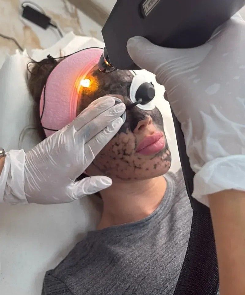 Un profesional sanitario utiliza un dispositivo portátil en el rostro del paciente durante un tratamiento estético