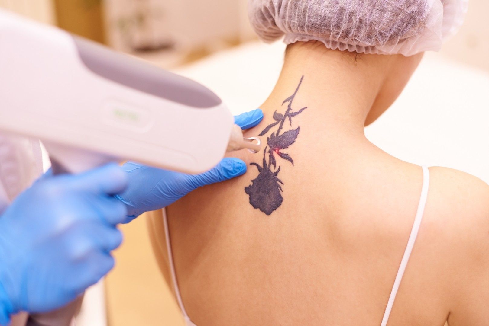Eliminación de un tatuaje con láser en la nuca de una persona