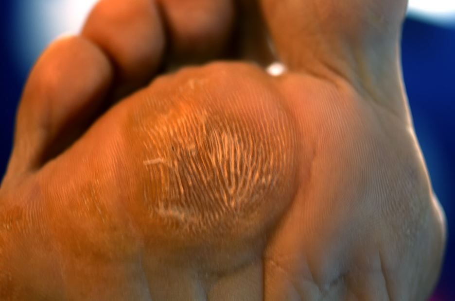 Planta del pie con callos y piel seca y agrietada.