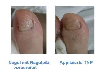 Teilnagelprothetik von Podologie Garn in Heiligkreuz/Mels