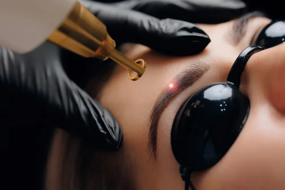 Eliminación de tatuajes con láser en las cejas, persona con gafas de seguridad, dispositivo dorado, guantes negros.