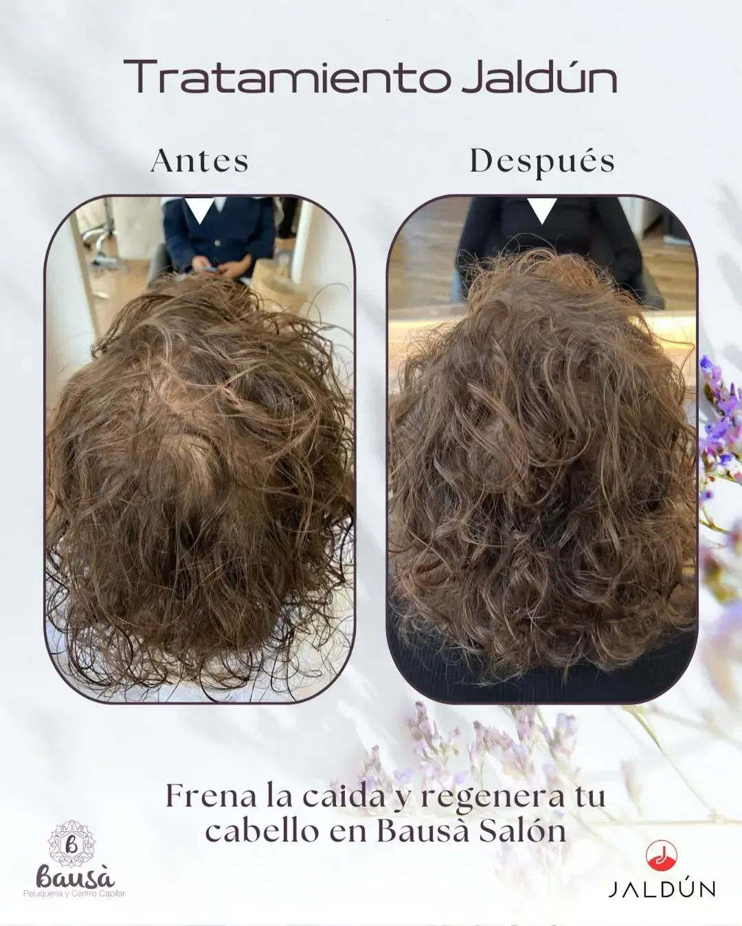 Fotos del antes y el después que muestran una mayor densidad capilar tras un tratamiento 