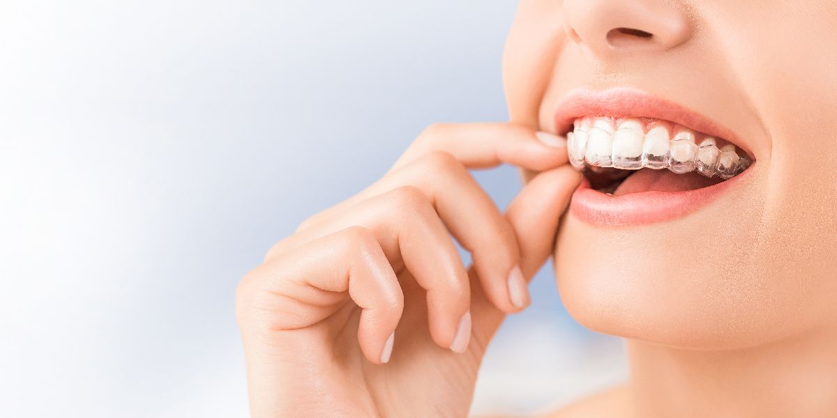 Femme tenant un aligneur pour ses dents
