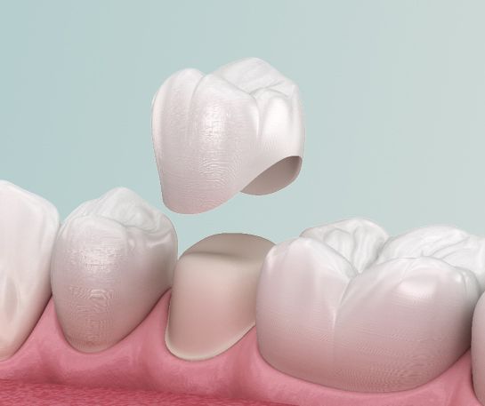 Couronne sur une dent en illustration 3D