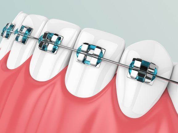 Bagues dentaires en illustration 3D