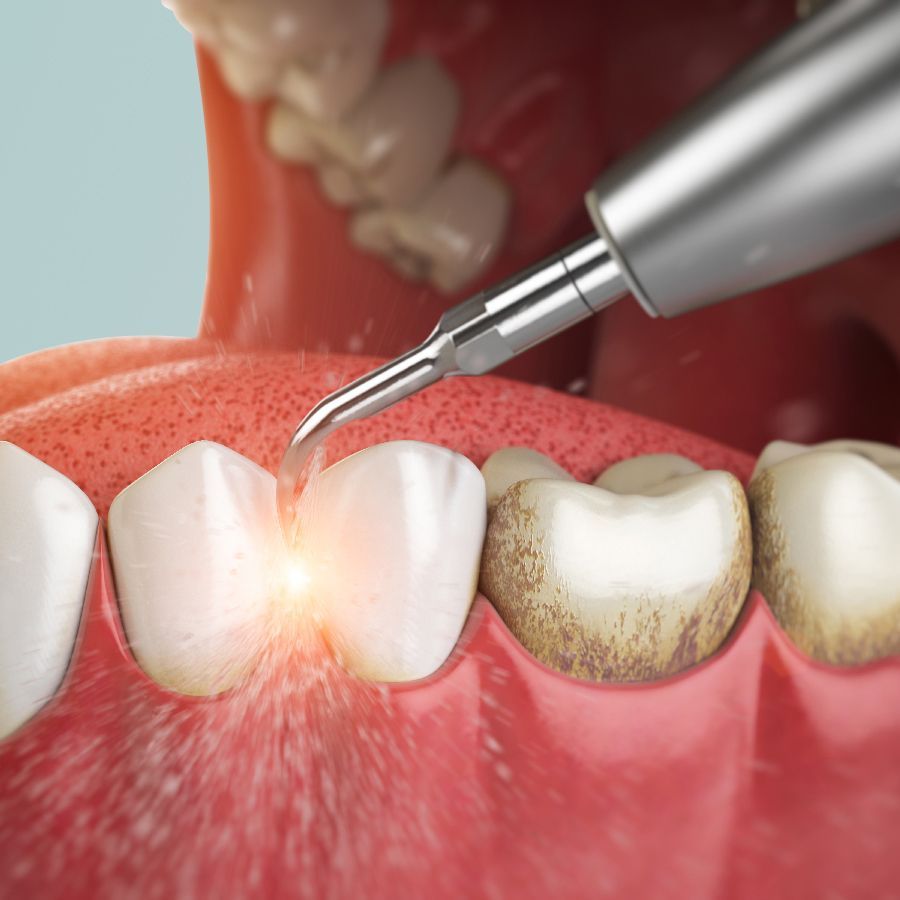 Détartrage des dents illustration en 3D