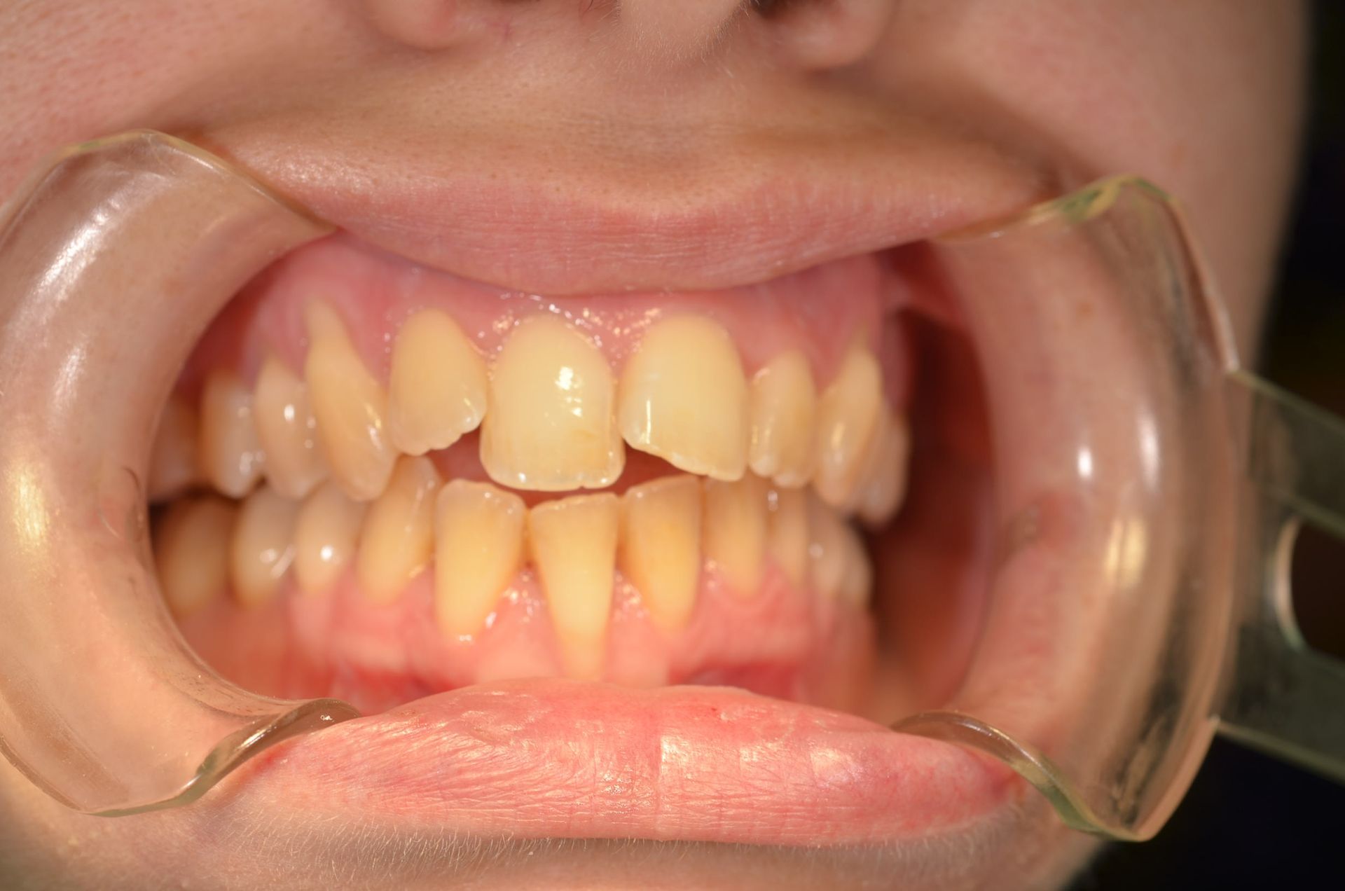 Bambino con denti storti.