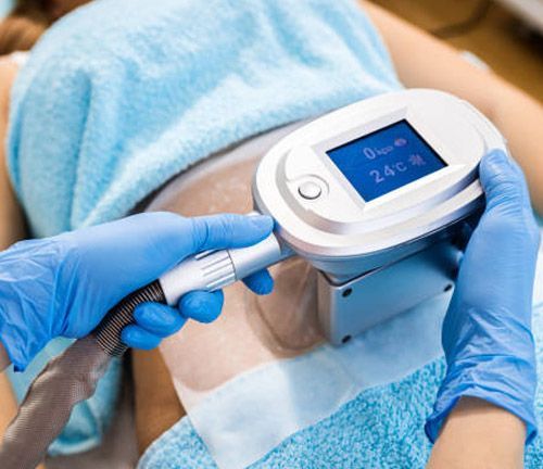 Un profesional con guantes azules utiliza un dispositivo de criolipólisis en el abdomen de un paciente para reducir la grasa.