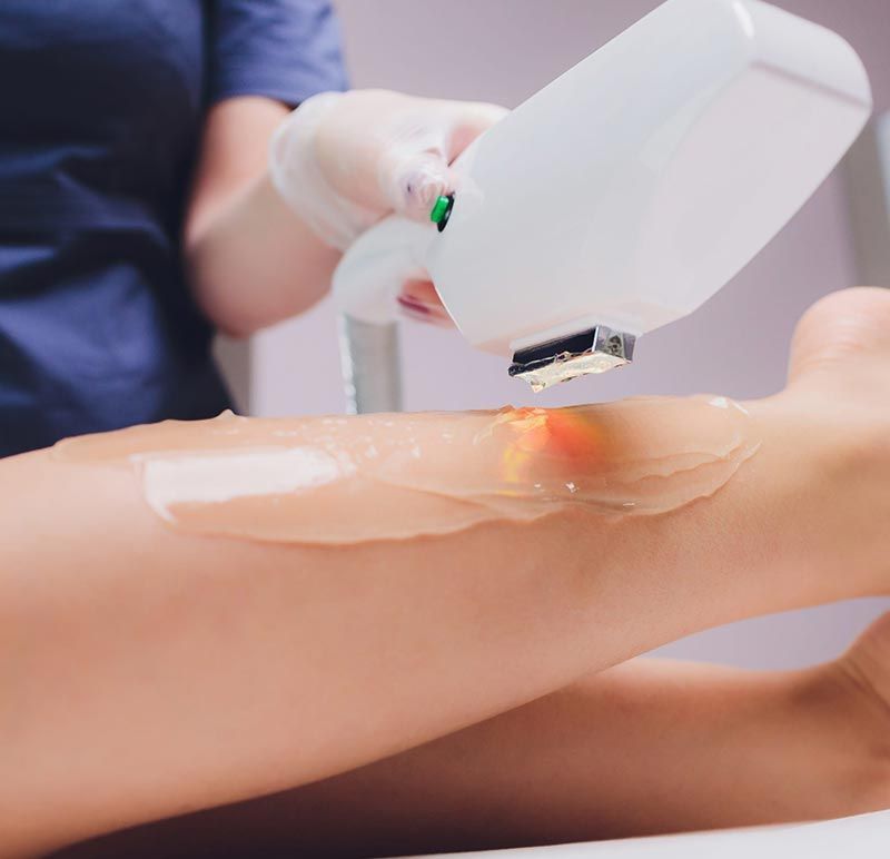 Una profesional utilizando un dispositivo de depilación láser en una pierna cubierta con gel refrescante.
