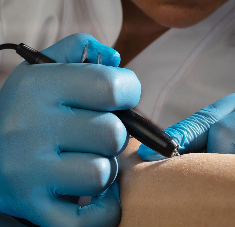 Una mano enguantada utiliza un lápiz eléctrico para tratamientos cutáneos en el brazo de una persona.