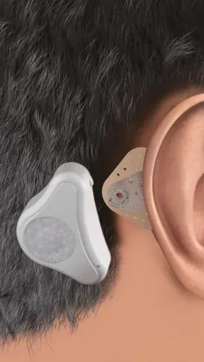 Appareil auditif avec implant derrière l'oreille