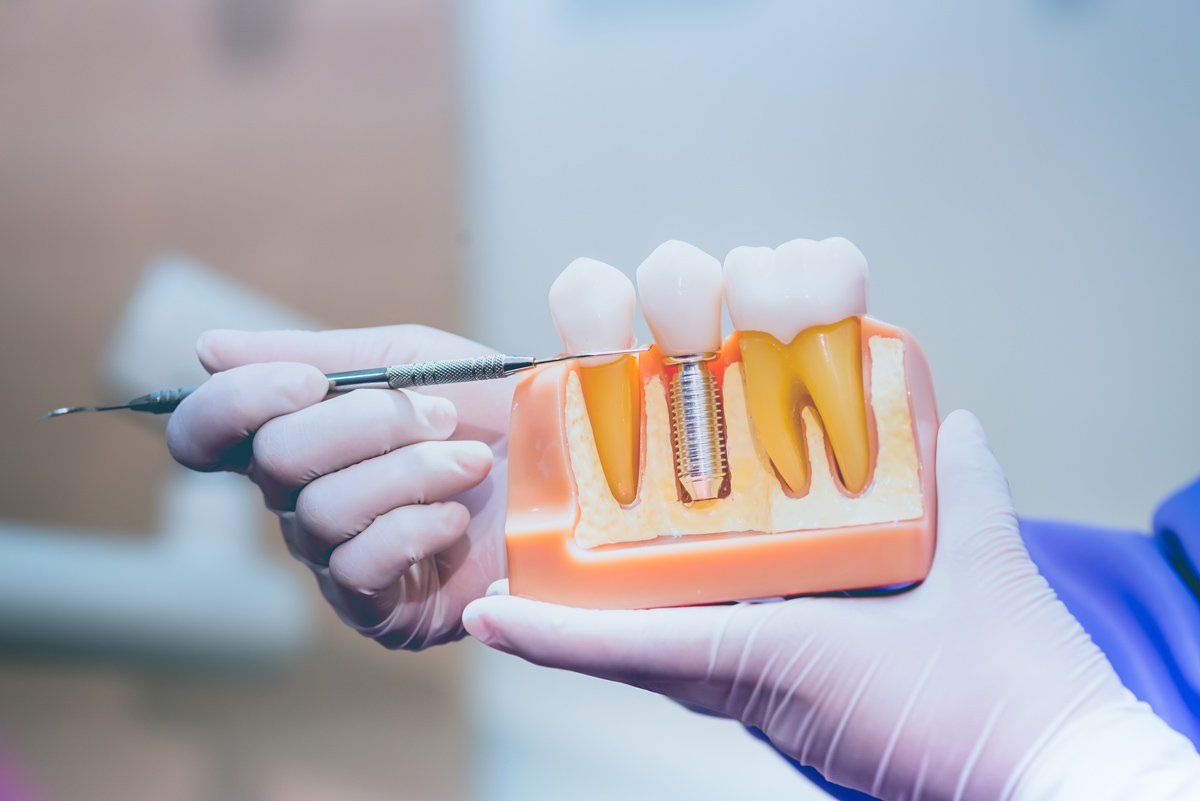 Dentiste expliquant l'implant dentaire avec un modèle