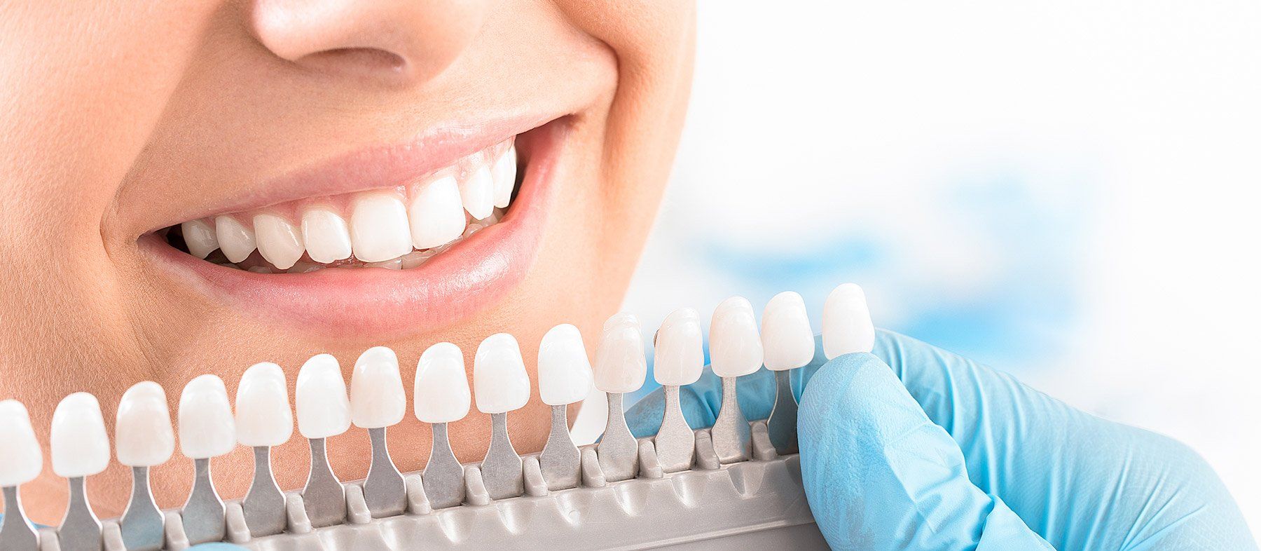 Panoplie de facettes dentaires pour une patiente