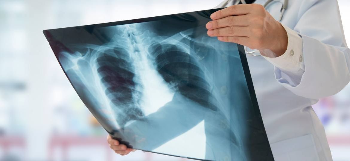 Un médico sostiene una radiografía de los pulmones de una persona.
