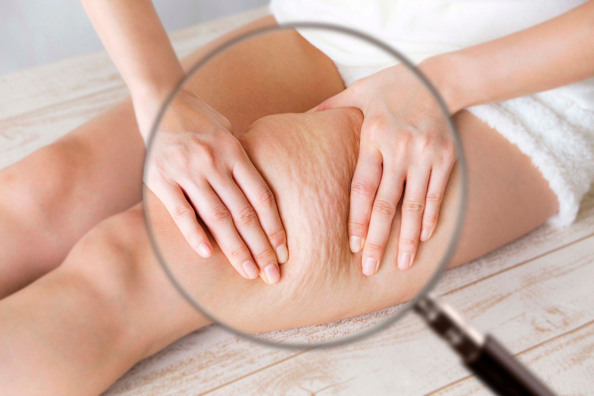 Die Beine einer Frau sind vergrößert, um Cellulite zu zeigen, die Hände drücken auf die Haut.