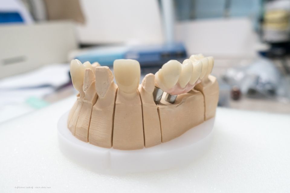 Peter Schnirring Zahnarzt – ein künstliches Kiefermodell mit Zahnimplantaten in der Nahaufnahme 