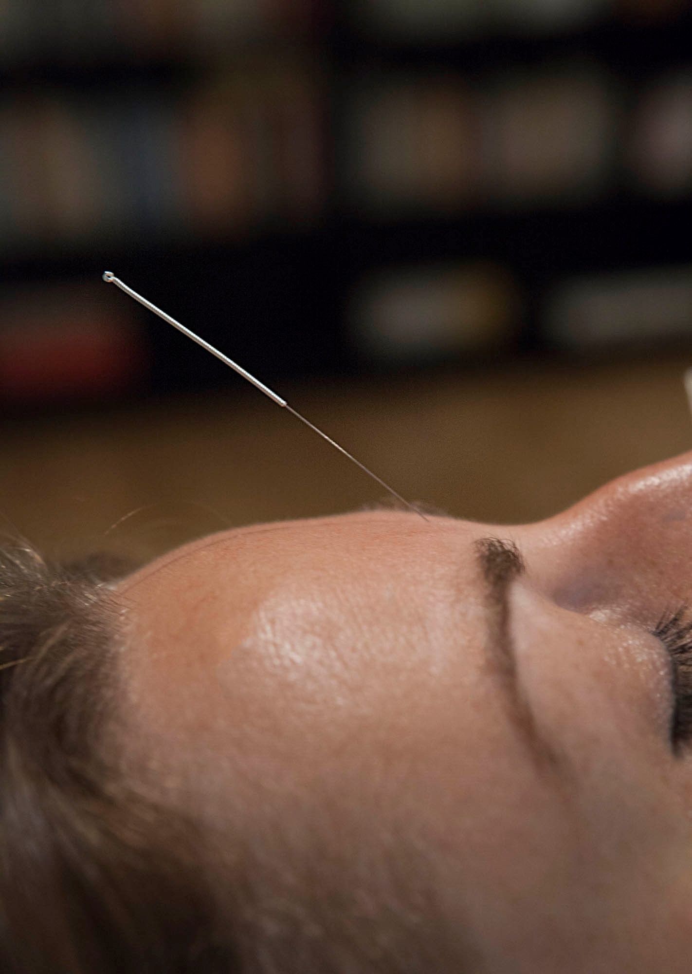 Une femme reçoit un traitement d'acupuncture sur le dos.