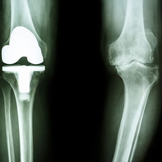 Una radiografía de una rodilla con una rodilla protésica.