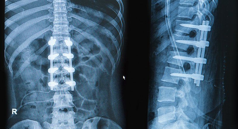 Una radiografía de la columna vertebral de una persona con un aparato ortopédico puesto.