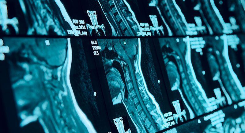 Un primer plano de una resonancia magnética de la columna vertebral de una persona.