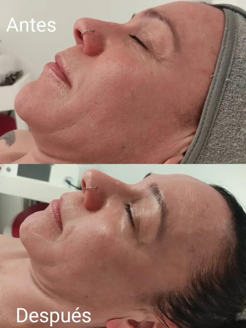 Comparación facial de perfil antes y después, que muestra una piel más tersa y un puente nasal más elevado.