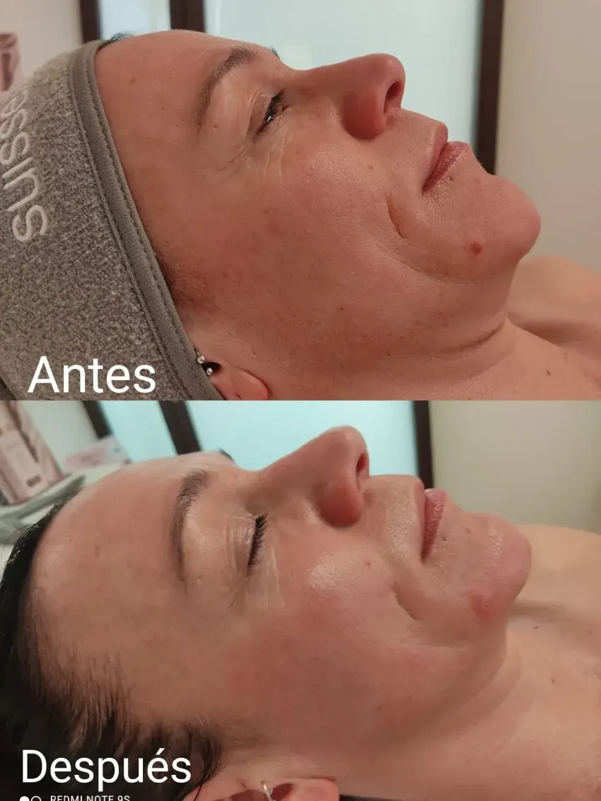 Imagen de perfil de una persona acostada, antes y después del tratamiento, que muestra una piel más tersa.