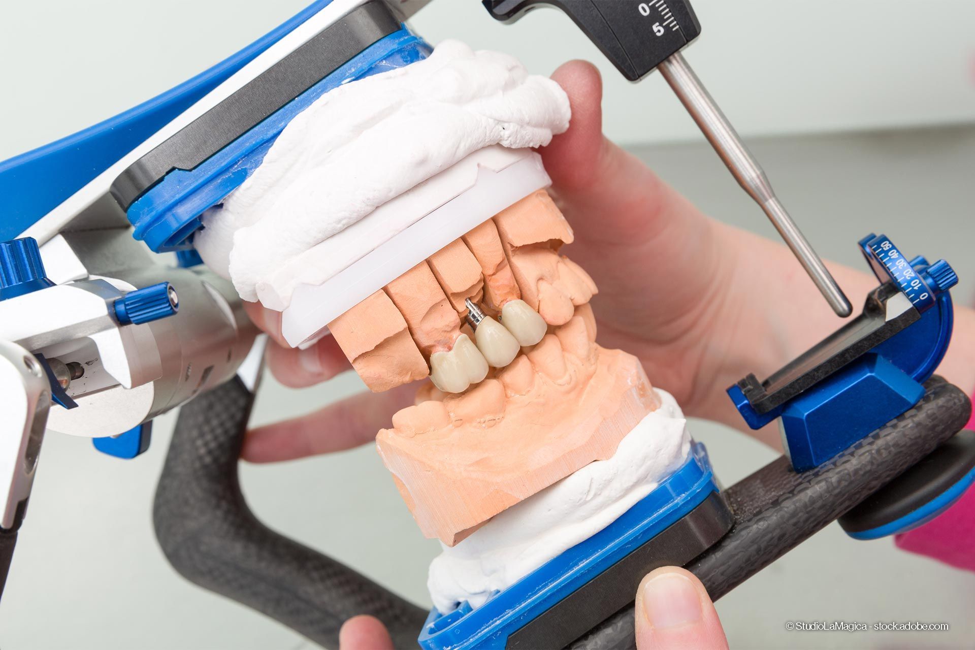 Herstellung von Zahnimplantaten im Zahntechnik Labor Mühling