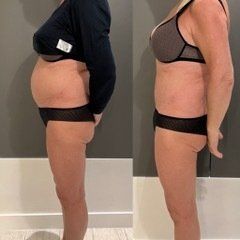 Perte de ventre avec la crylipolyse