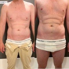 Perte de ventre avec la crylipolyse pour homme